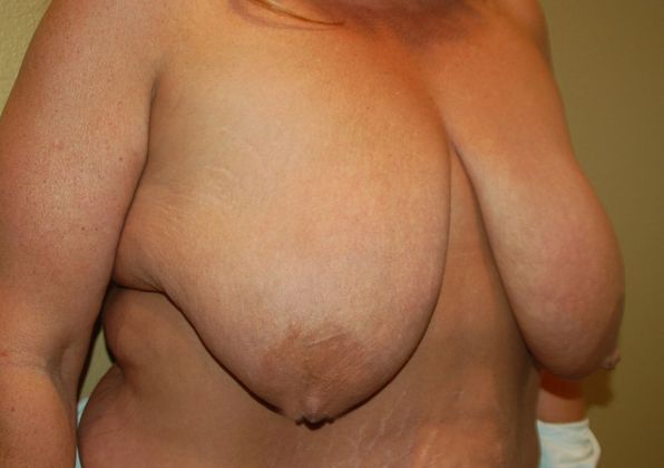 Breast Augmentation w/ Lift: Case 244 - Before
