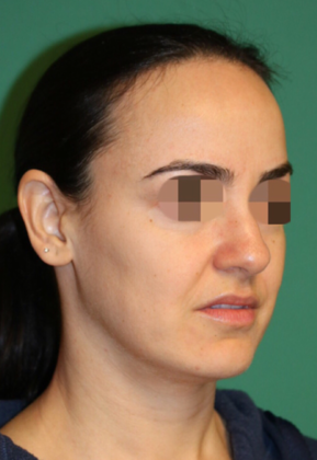 Hairline Lowering Surgery: Case 4 - Before