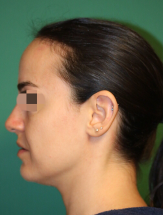Hairline Lowering Surgery: Case 4 - Before