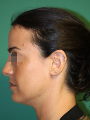 Hairline Lowering Surgery: Case 4 - After