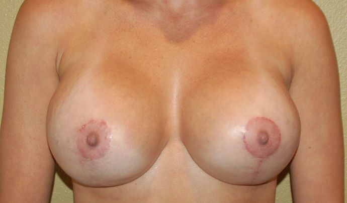 Breast Augmentation w/ Lift Case 246 - After