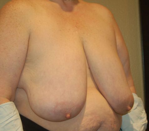 Breast Reduction: Case 57 - Before