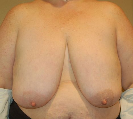 Breast Reduction: Case 57 - Before