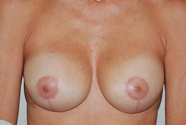 Breast Revision: Case 93 - After