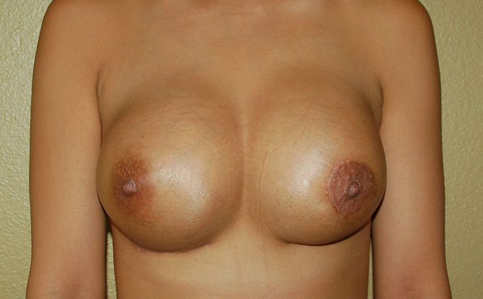 Breast Revision: Case 94 - After