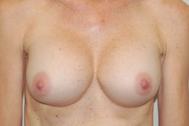 Breast Revision: Case 95 - Before