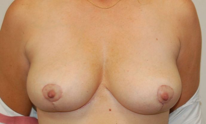 Breast Revision: Case 100 - After