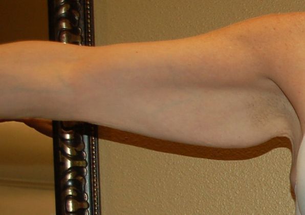 Brachioplasty Case 9 - Before