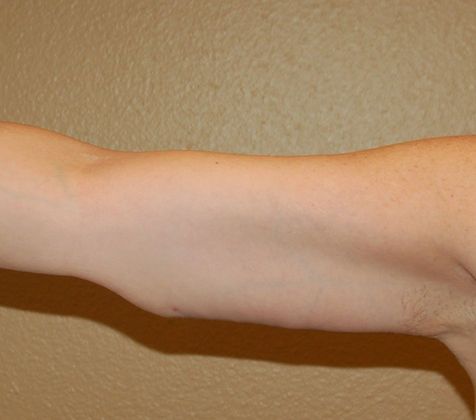 Brachioplasty Case 9 - After