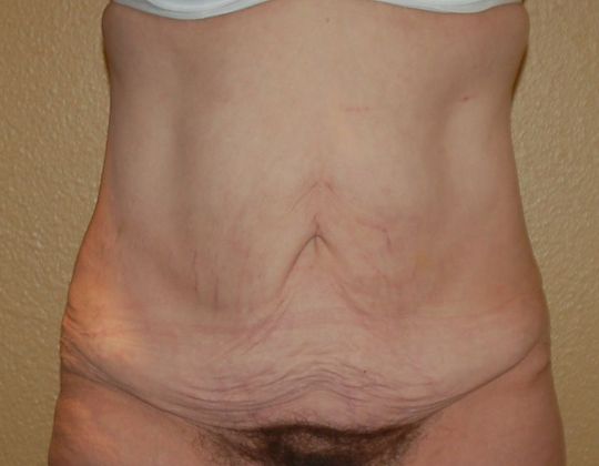 Massive Weight Loss  Case 49 - Before