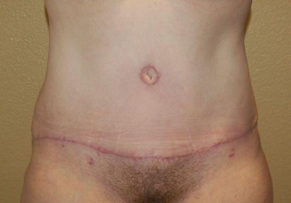 Massive Weight Loss  Case 49 - After