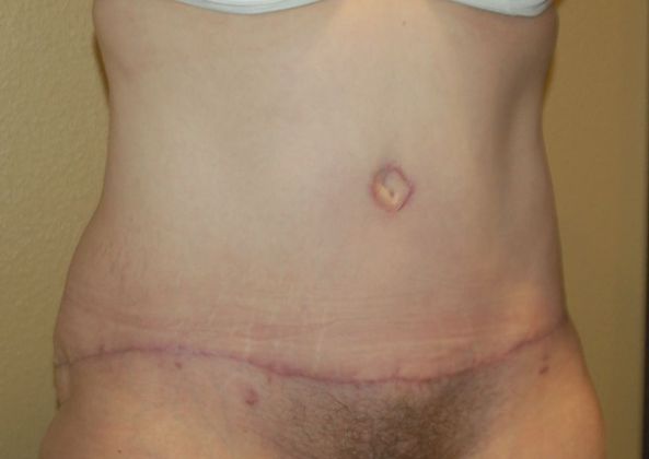 Massive Weight Loss : Case 49 - After