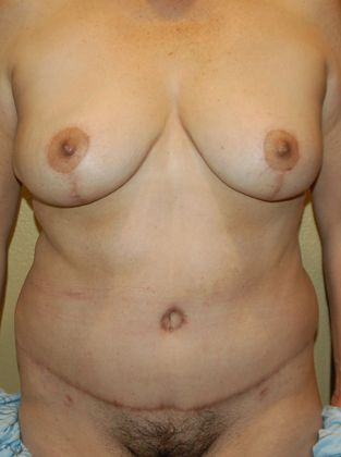 Mommy Makeover Case 108 - After