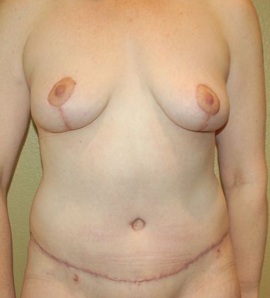 Mommy Makeover Case 109 - After