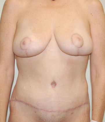 Massive Weight Loss : Case 50 - After