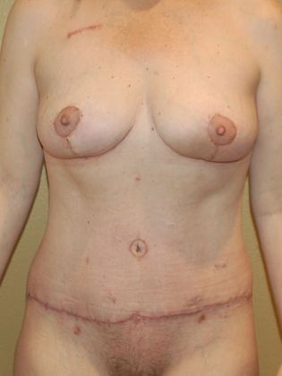 Massive Weight Loss  Case 51 - After