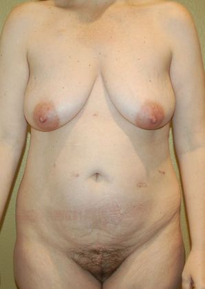 Massive Weight Loss  Case 51 - Before
