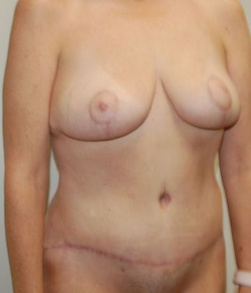 Mommy Makeover: Case 111 - After