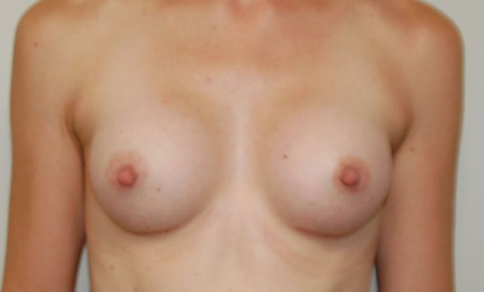 Breast Augmentation Case 520 - After