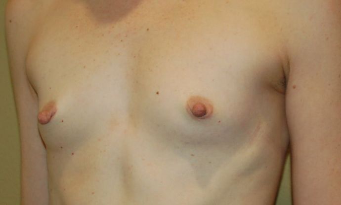 Breast Augmentation: Case 520 - Before