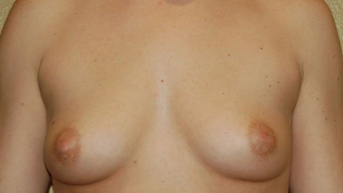 Breast Augmentation Case 521 - Before