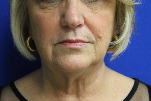 CoolSculpting®: Case 3 - After (1 SESSION/2 APPLICATORS)