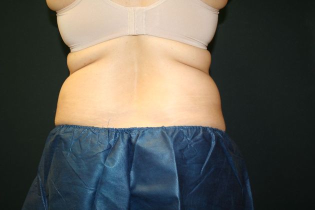 CoolSculpting®: Case 4 - Before