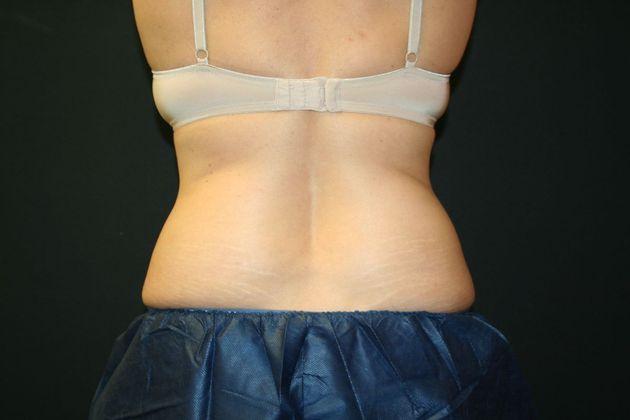 CoolSculpting®: Case 4 - After
