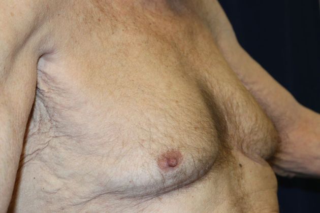 Male Breast Reduction* Case 4 - Before