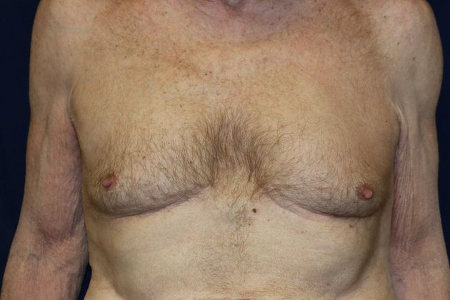 Male Breast Reduction*: Case 4 - Before