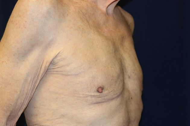 Male Breast Reduction* Case 4 - After