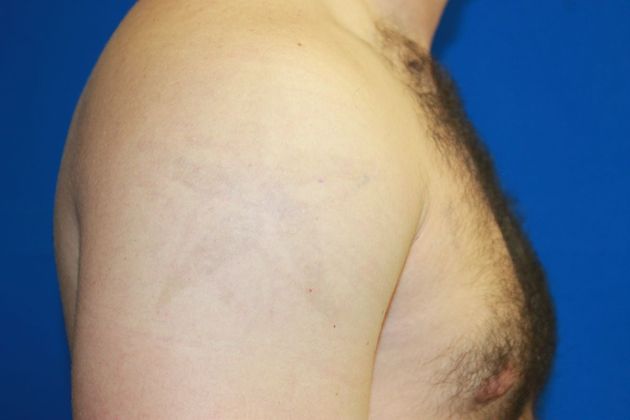 After Tattoo Removal