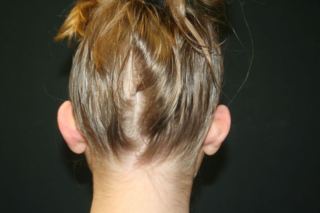 Otoplasty Case 3 - Before