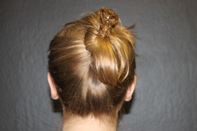 Otoplasty Case 3 - After