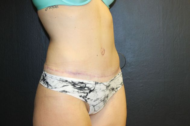 Abdominoplasty Case 14 - After
