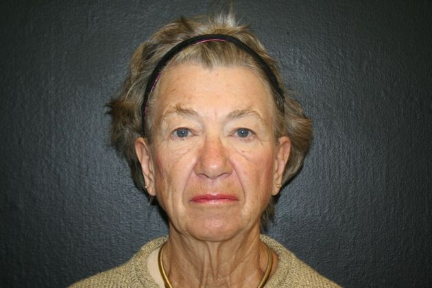 Blepharoplasty: Case 7 - Before