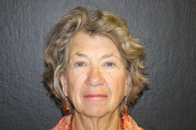 Blepharoplasty: Case 7 - After