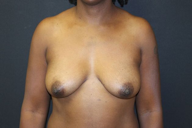 Mastopexy Case 17 - Before