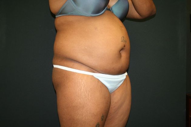 Abdominoplasty Case 15 - Before