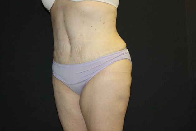 Abdominoplasty Case 16 - After