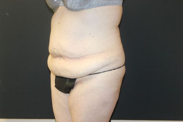 Abdominoplasty Case 16 - Before