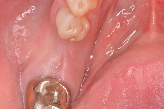 Dental Implants: Case 5 - Before implant