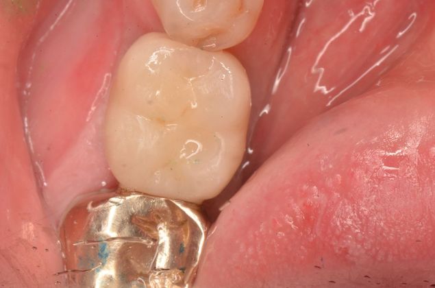Dental Implants: Case 5 - After implant crown