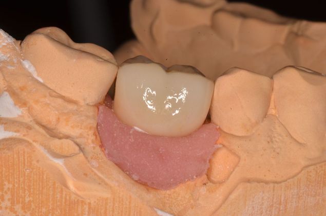 Dental Implants: Case 5 - Lab crown