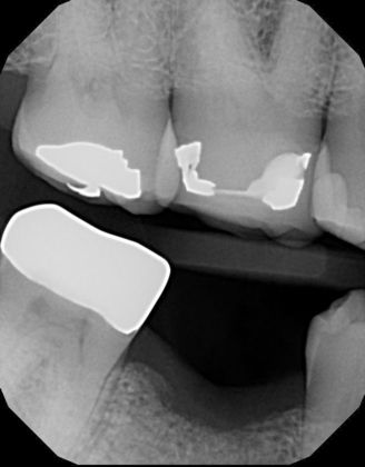 Dental Implants: Case 5 - Before Radiograph