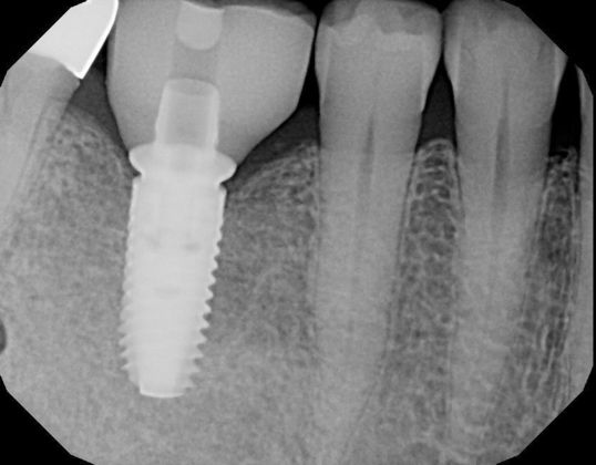 Dental Implants: Case 5 - After Radiograph