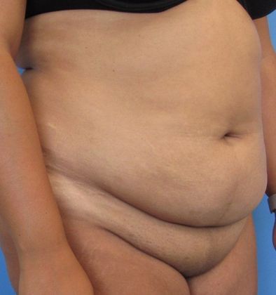 Liposuction: Case 11 - Norwalk, Liposuction - Before