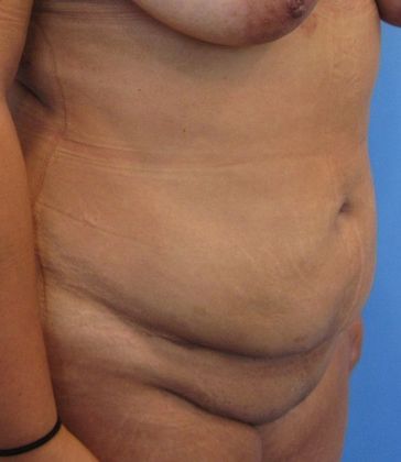 Liposuction: Case 11 - Norwalk, Liposuction - After