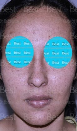 Rhinoplasty Minimal changes to have a great nose - Before