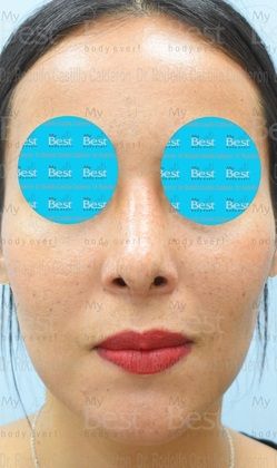 Rhinoplasty Minimal changes to have a great nose - After